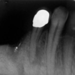 Zahn 44, apikale Parodontitis im Januar 2009