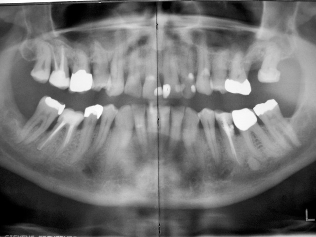 stabile Verhältnisse im Januar 2010: die wurzelbehandelten Zähne sind unauffällig, auch der Herd an Zahn 46 ist vollständig ausgeheilt, Zahn 27 musste nach Längsfraktur extrahiert werden