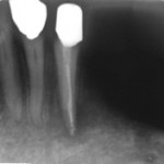 Kontrolle Zahn 33 nach Aufbau mit Glasfaserstift und prothetischer Versorgung im Juni 2009