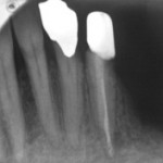 Kontrolle Zahn 33 im April 2010, vollständige knochendichte Ausheilung