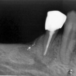 Kontrolle im April 2010, vollständige Ausheilung mit Resorption des überpressten Sealers